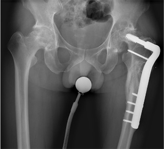 Total Hip Replacement