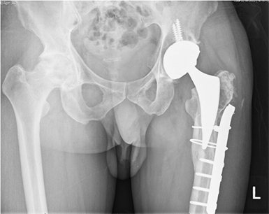 Total Hip Replacement