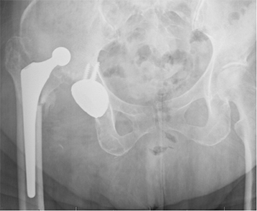 Revision Hip Replacement