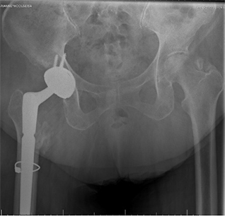 Revision Hip Replacement