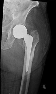 Revision Hip Replacement