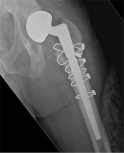 Revision Hip Replacement