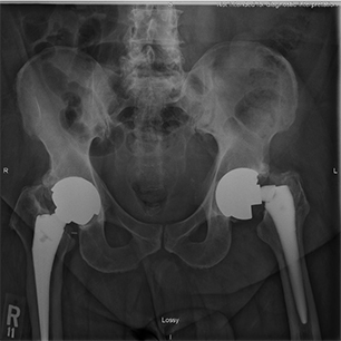 Revision Hip Replacement