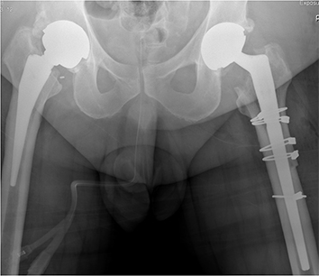 Revision Hip Replacement