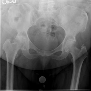Total Hip Replacement