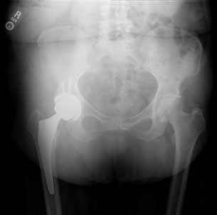 Total Hip Replacement