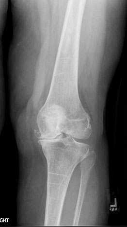    Total Knee Replacement 