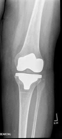  Total Knee Replacement 