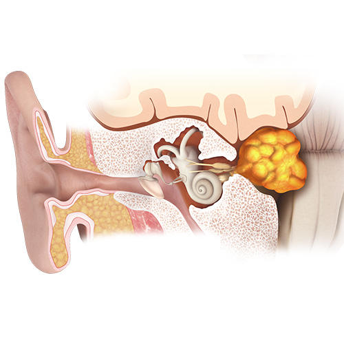 Acoustic Neuroma