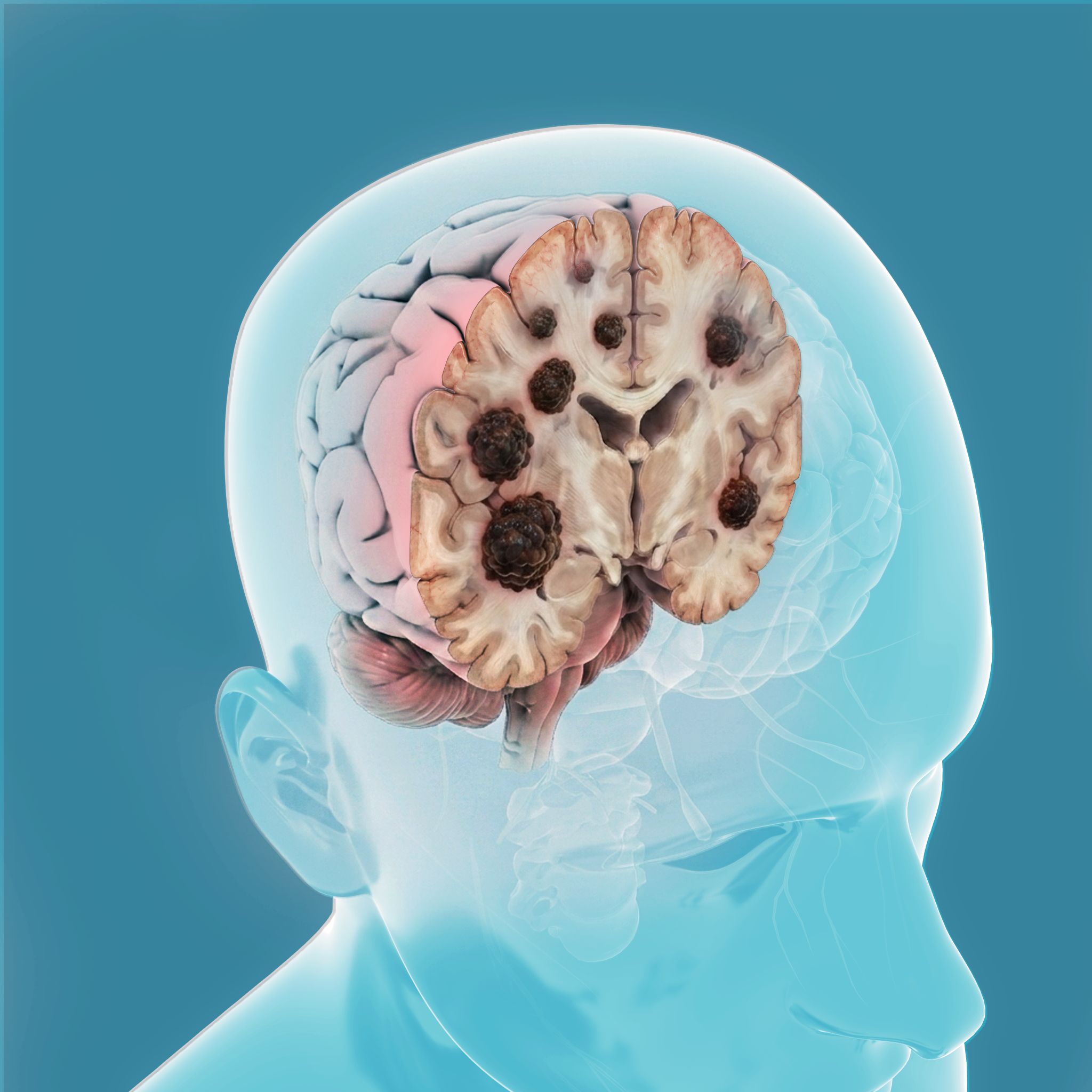 Brain Metastasis