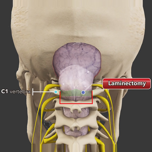 Chiari Malformation