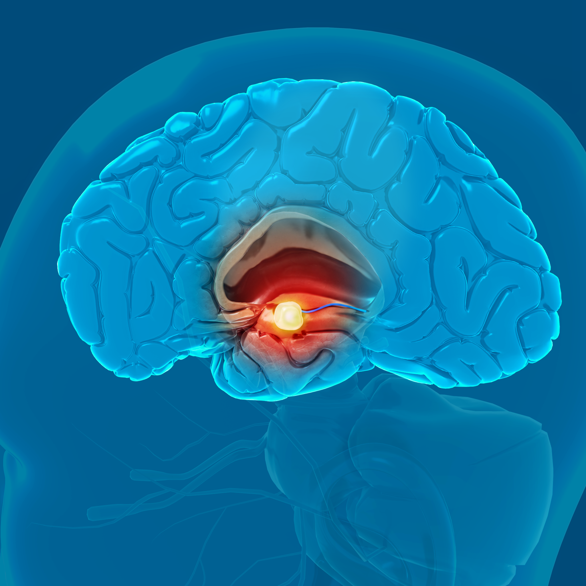 Colloid Cysts