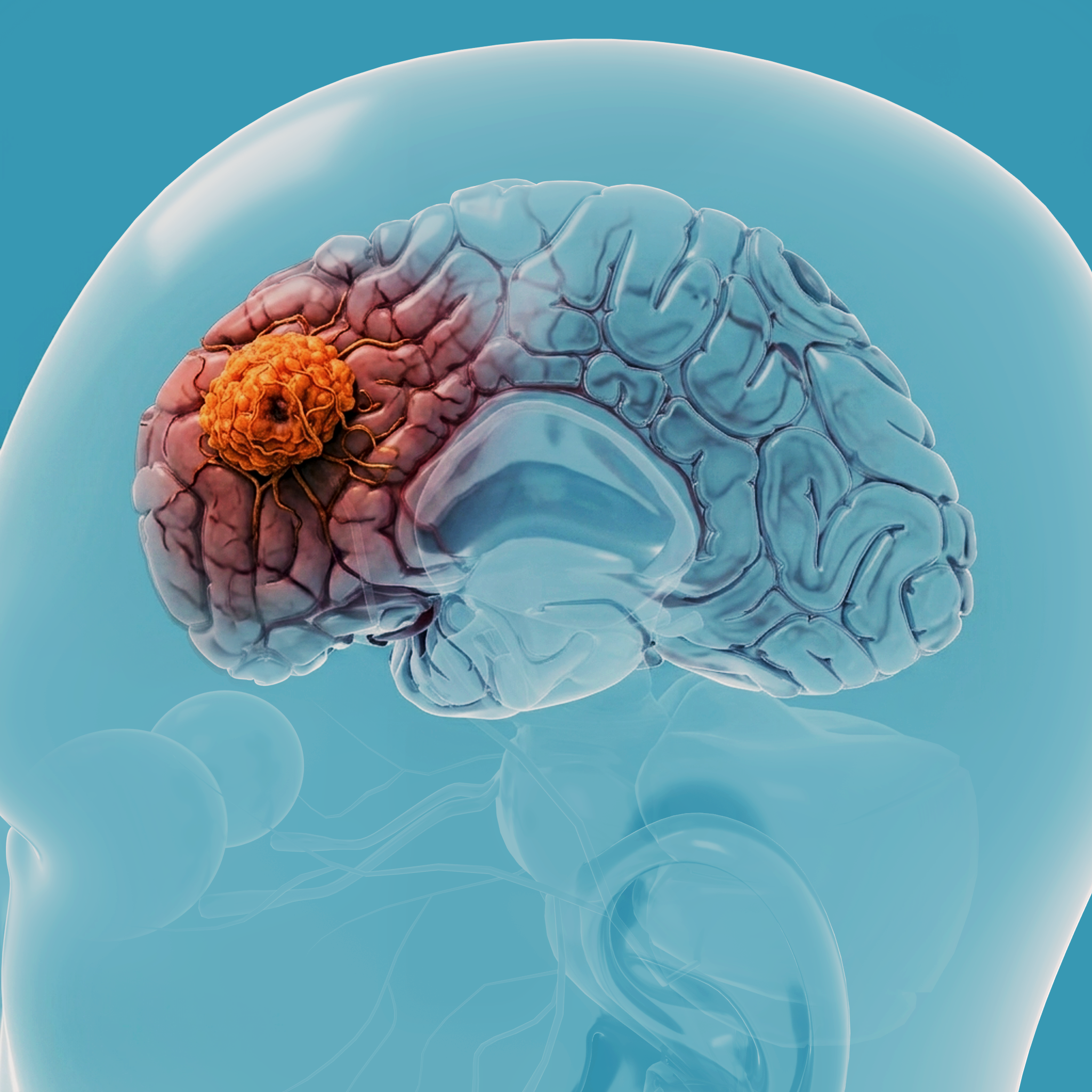 Glioblastoma
