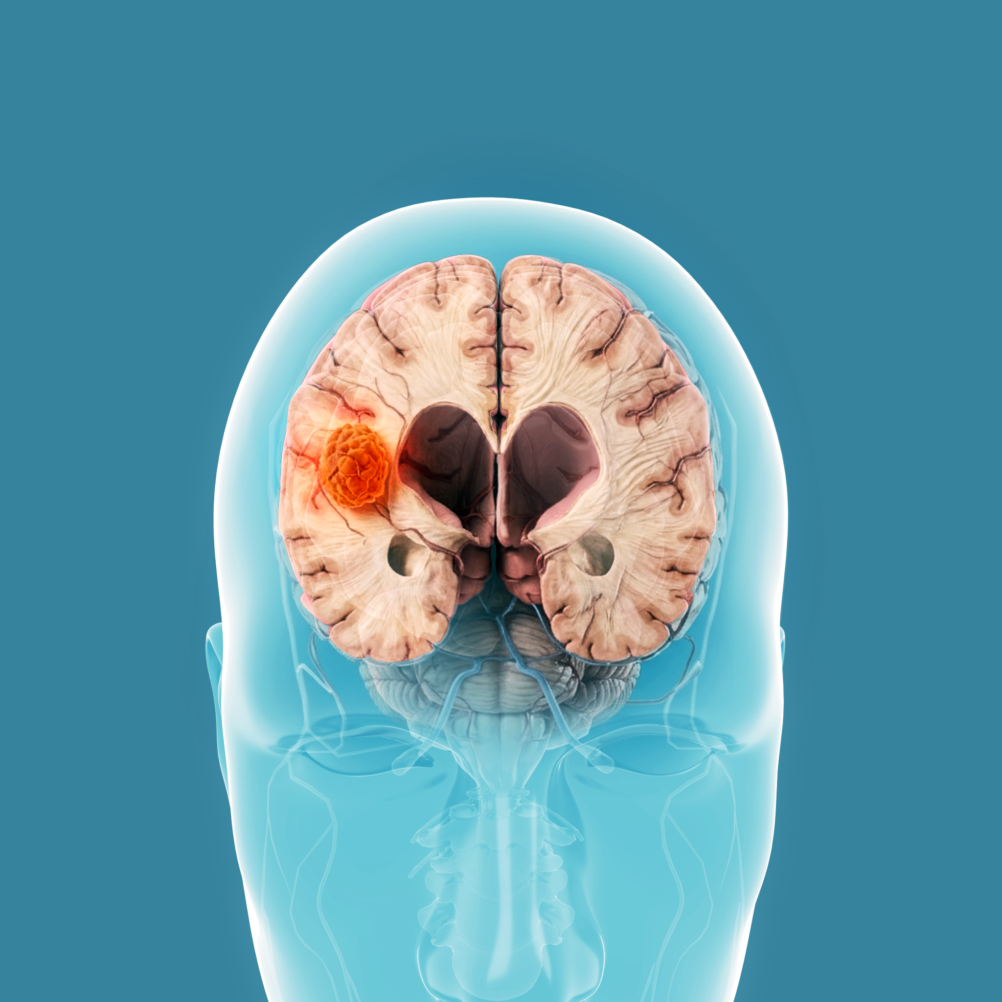 Gliomas