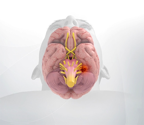 Glossopharyngeal/Vagal Schwannoma