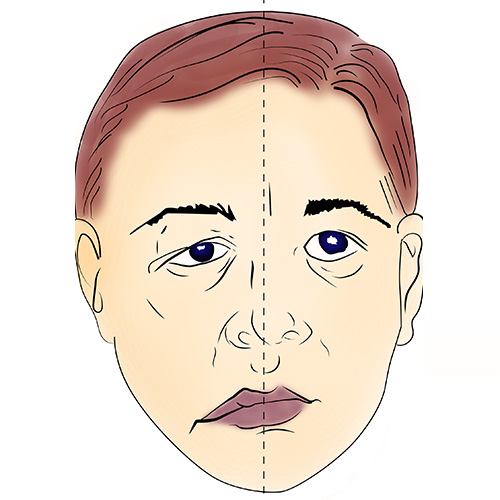 Hemifacial Spasm