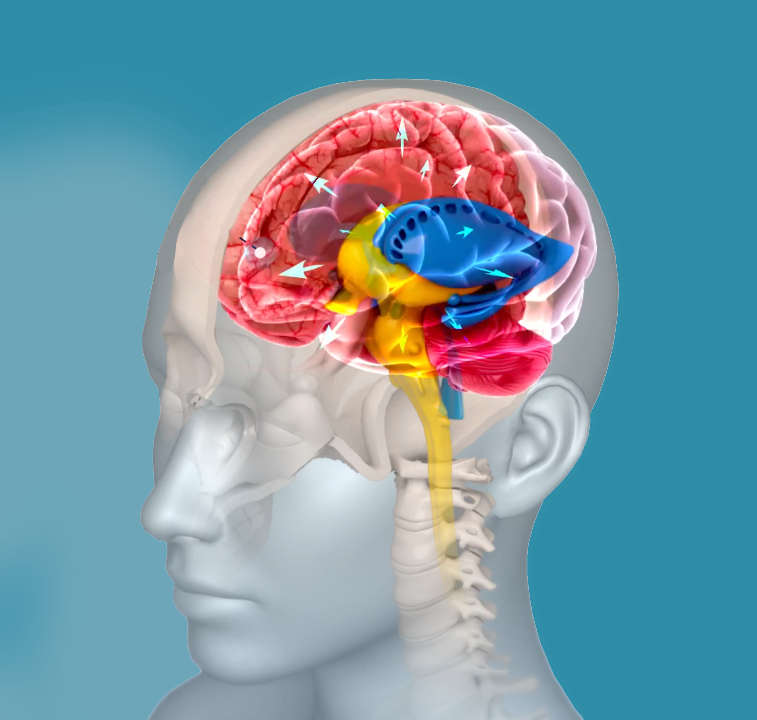 Idiopathic Intracranial Hypertension