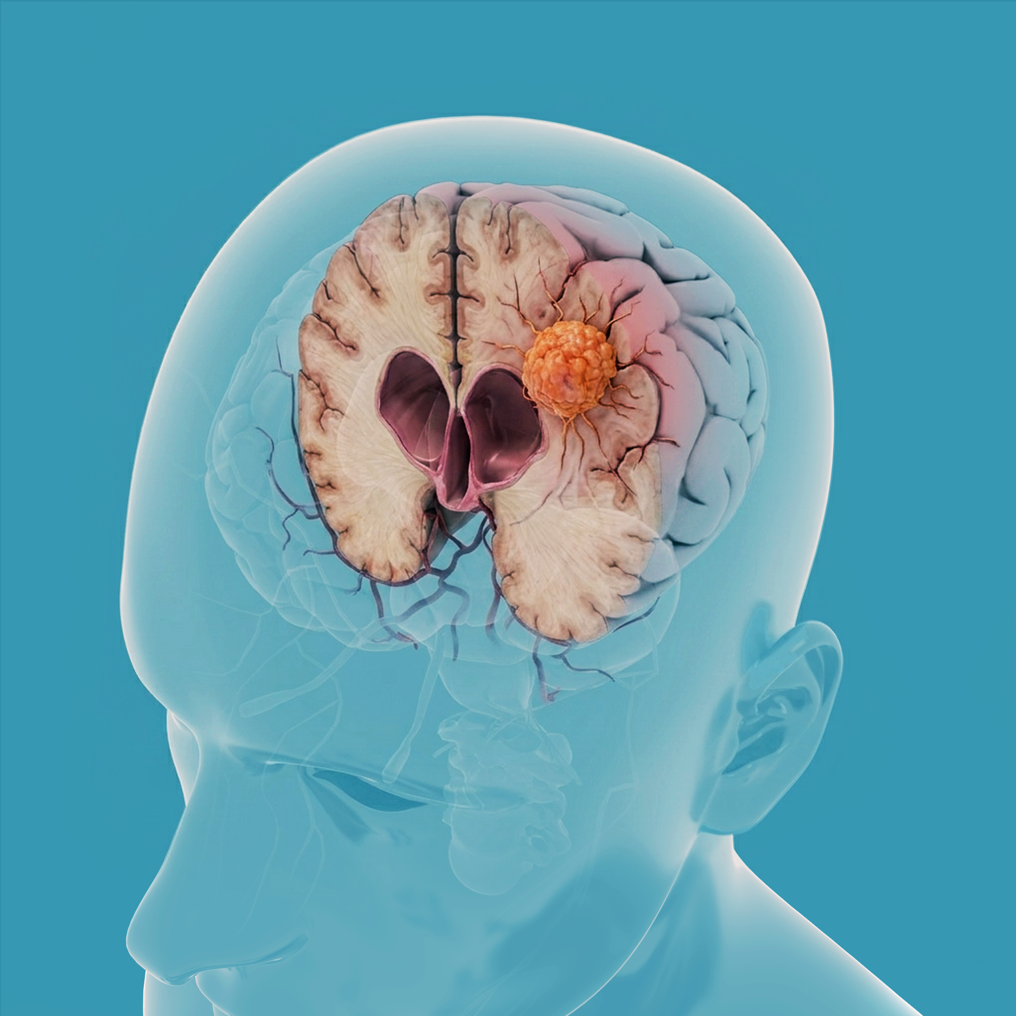 Low-grade Gliomas