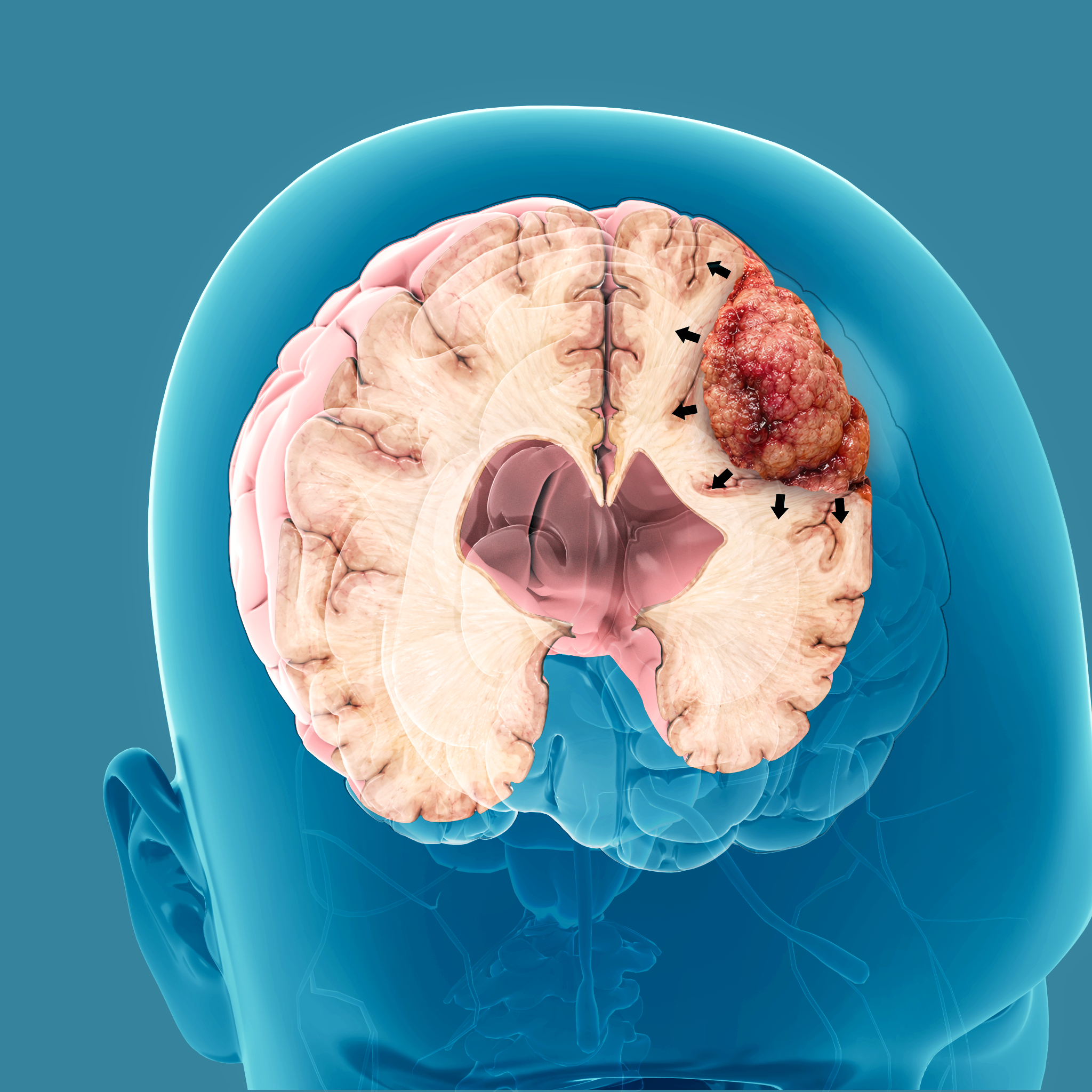 Meningiomas