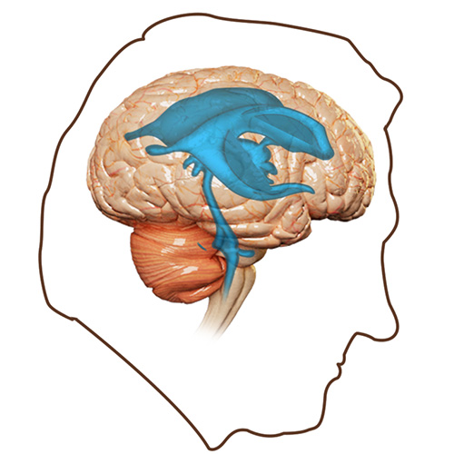 Normal Pressure Hydrocephalus