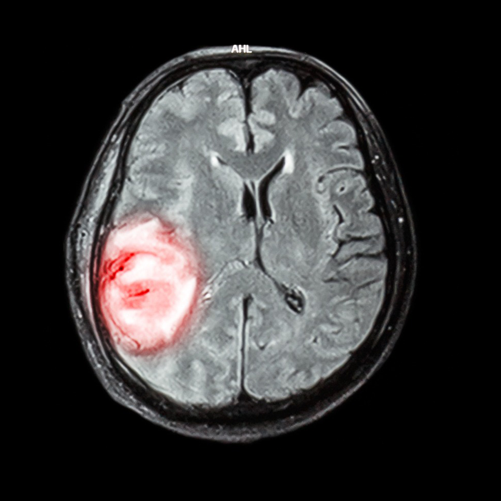 Oligodendrogliomas