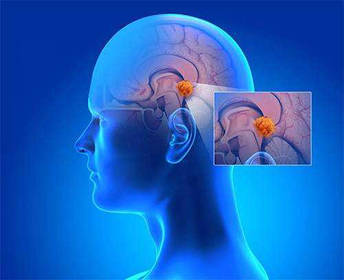 Pineal Region Tumours