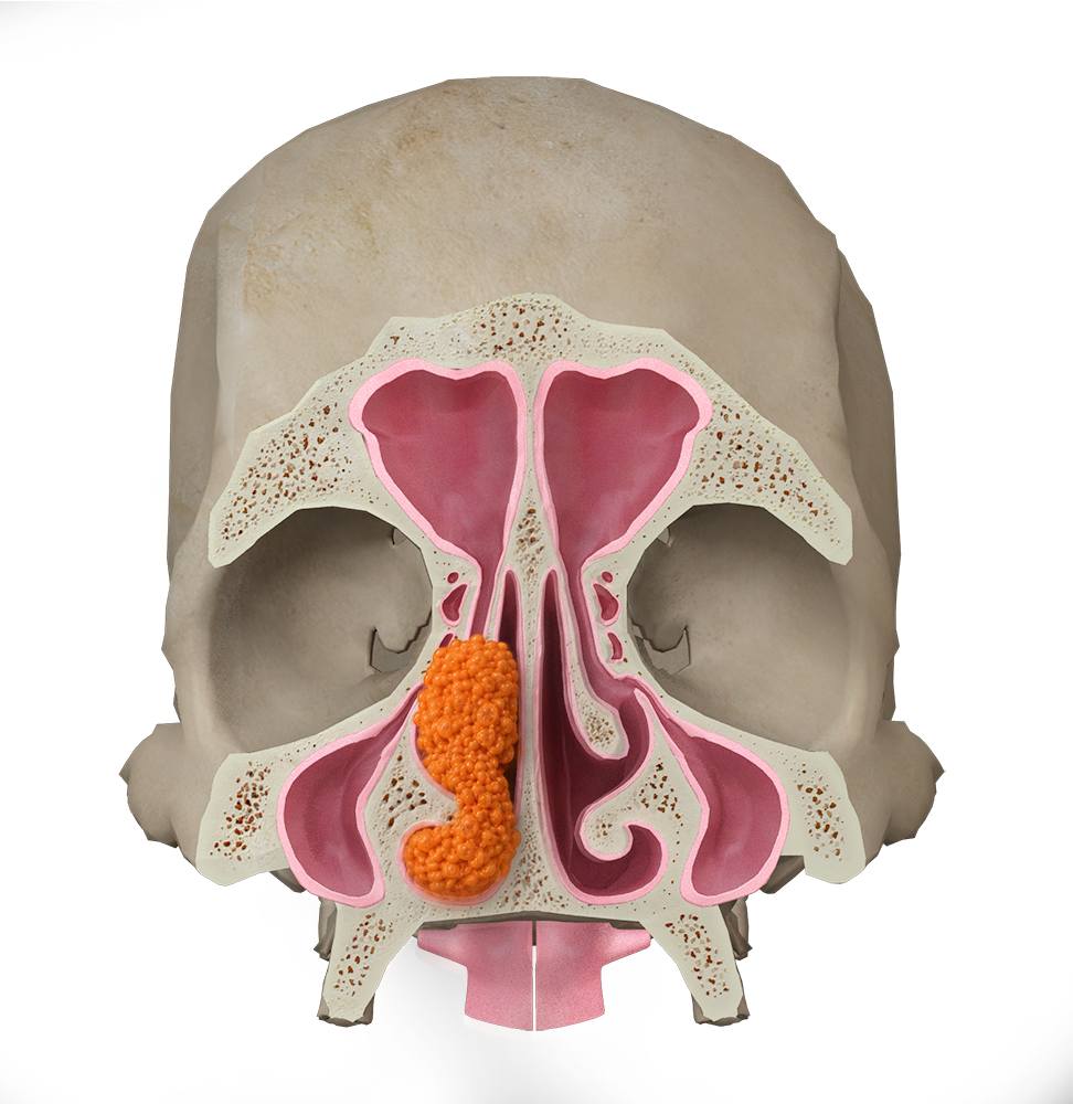 Sinonasal Cancers