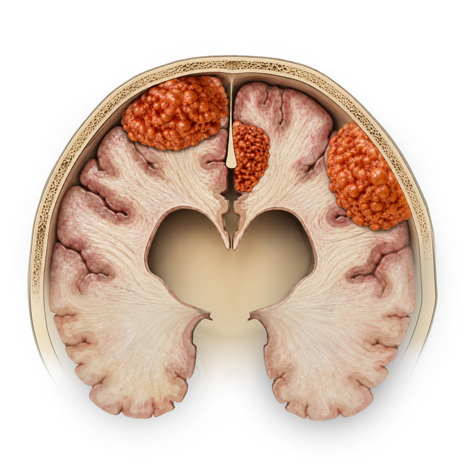 Skull Base Meningiomas