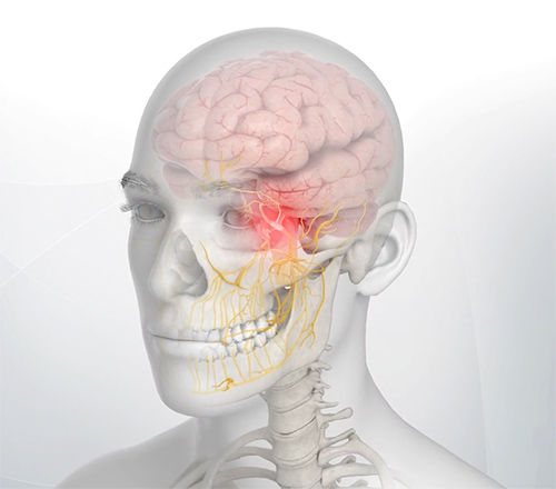 Trigeminal Neuralgia