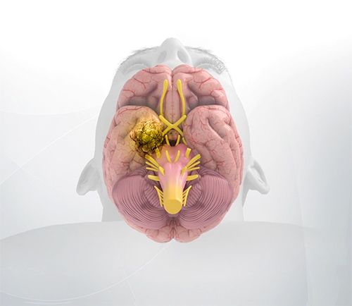 Trigeminal Schwannoma