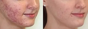 Acne treatment before and after - patient 1 results NYC