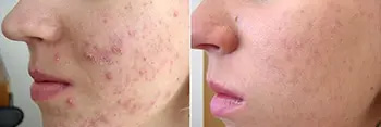 Acne treatment before and after - patient 2 results NYC