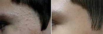 Acne treatment before and after - patient 3 results NYC