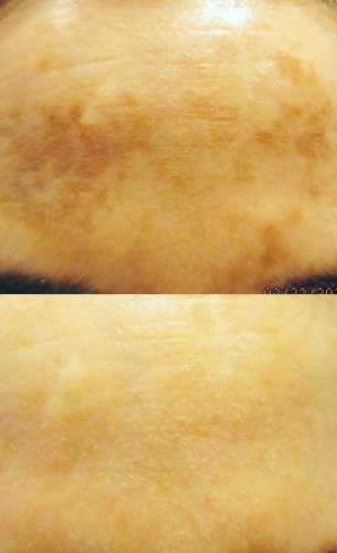 Treatments for Dark Spots