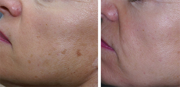 Age Spot Treatment NYC