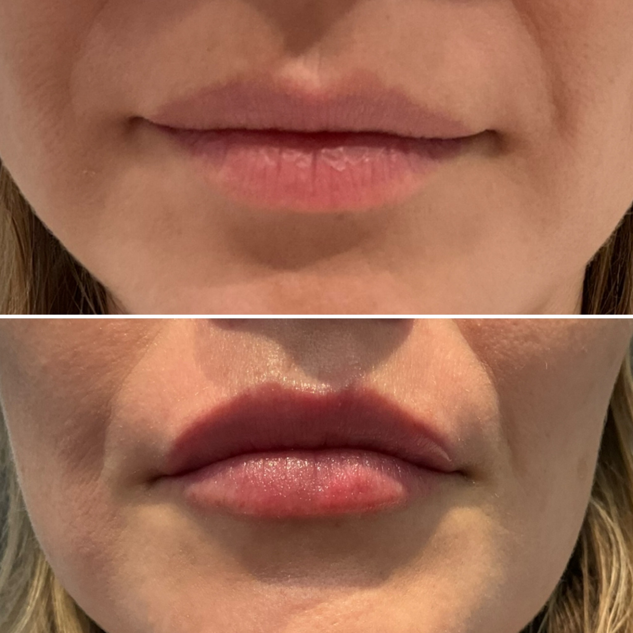 Before and after image of lip injections in NYC done by dermatologist Debra Jaliman, MD