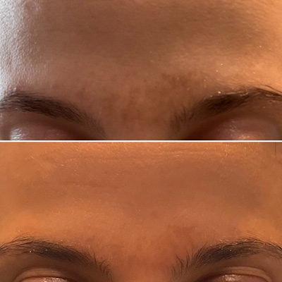 facial pigmentation laser therapy