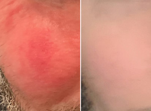 Rosacea after laser in Upper East Side, New York City by dermatologist, Debra Jaliman, MD