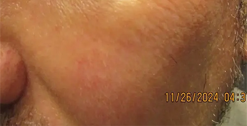Same patient's under-eye area after hyaluronidase dissolved the filler, treated by Dr. Debra Jaliman, NYC