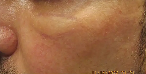 Under-eye area with incorrectly placed hyaluronic acid filler before hyaluronidase treatment by Dr. Debra Jaliman, NYC