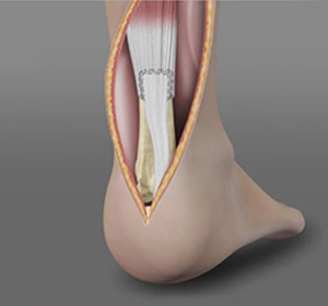 Achilles Tendon Repair img