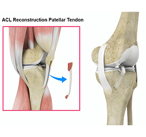 ACL Reconstruction img