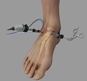 Ankle Arthroscopy img