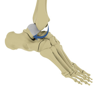 Ankle Dislocation img