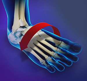 Ankle Instability img