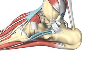 Ankle Ligament Reconstruction img