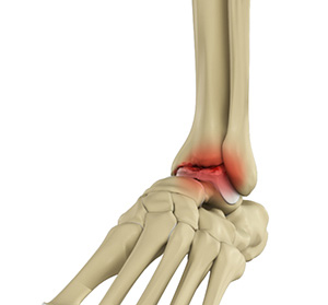 Ankle Pain img