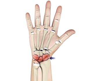 Arthritis of the Hand and Wrist img