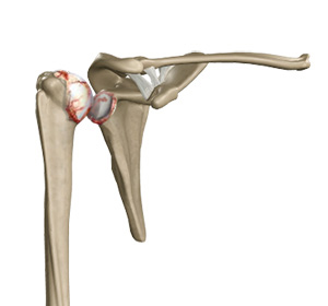 arthritis-shoulder img