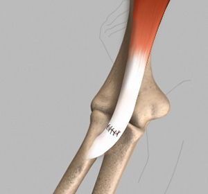 Biceps Tendon Repair img